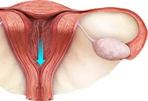 Menstrual Disorders Treatment