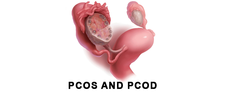 PCOS / PCOD Management